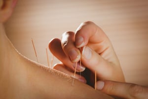 Can Acupuncture Provide a Solution to the Opioid Epidemic?